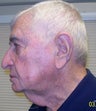 Neck Lift