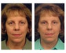 Lower Facelift and Neck