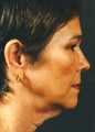 Necklift 