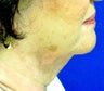Neck Lift