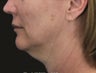 Neck Lift