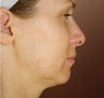 Neck Lift and Upper Eyelid Blepharoplasty