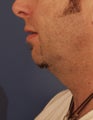 Neck lift