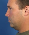 Neck lift