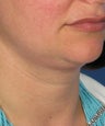 Neck lift