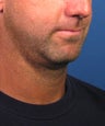 Neck lift