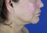 Facelift, Neck Lift, Lipocontouring of Neck