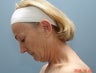 Neck Lift
