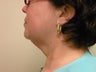 Neck Lift 