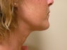 Neck Lift/Face Lift 
