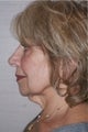 Neck Lift 