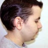 Submental Lipectomy and Neck Plasty 