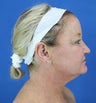 neck lift