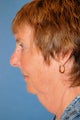 Weekend Necklift 