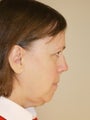 Neck Liposuction