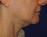 Neck Lift
