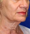 Neck Lift 