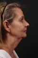 Neck lift
