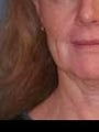 Facial Refinement: Necklift