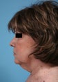 Neck lift