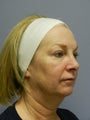 Neck Lift 