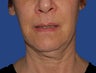 Jawline / Neck Lipo