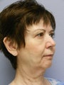 Lower Face Neck Lift 