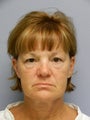 Lower Face with Neck Lift
