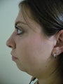 Neck Lift