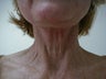 Neck lift