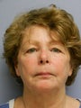 Lower Face with Neck Lift