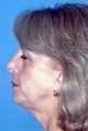 Neck Lift