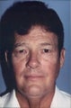 Male Neck Lift
