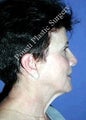 Neck Lift
