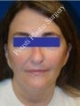 Face Lift, Facial Enhancement, Neck Lift