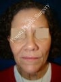 Face Lift, Neck Lift