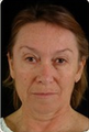 Neck Lift