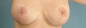 Areola Reduction and Breast Augmentation