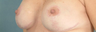 Areola Reduction/Breast Augmentation
