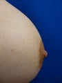 Nipple Reduction Surgery