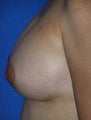 Nipple Reduction Surgery