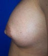 Nipple Reduction Surgery