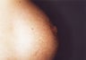 Nipple Reduction