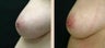 Inverted Nipple Repair