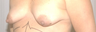 Areola Reduction/Breast Augmentation