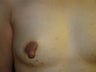 Nipple Reduction Surgery