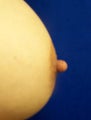 Nipple Reduction Surgery