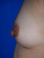 Nipple Reduction Surgery