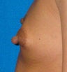 Nipple Reduction Surgery