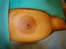 Inverted Nipple Repair